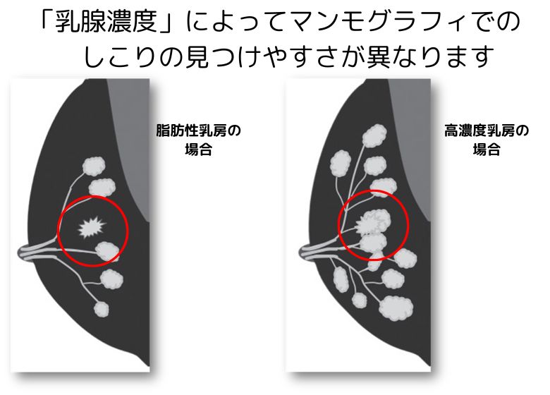 高濃度乳房（デンスブレスト）の検診はどうしたら？