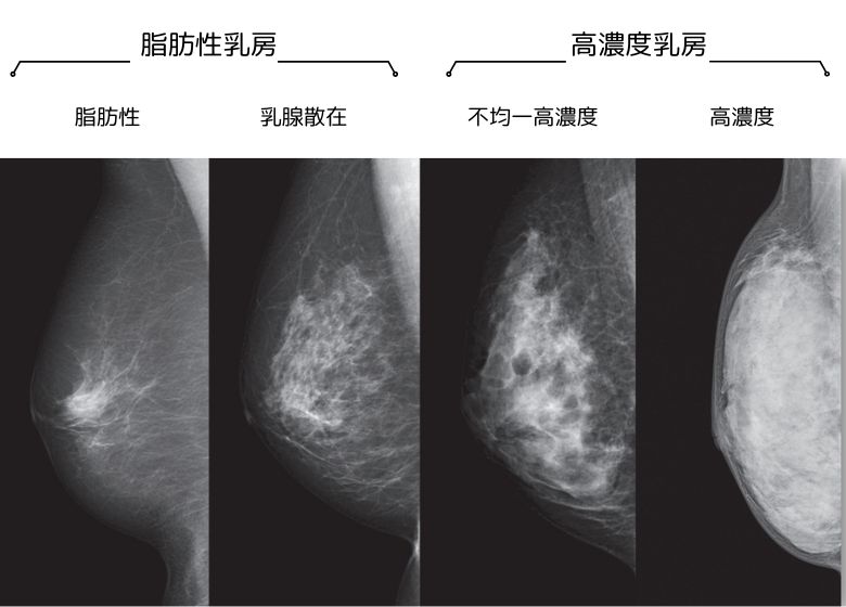 【乳房のタイプは4つに分けられます　～あなたはどのタイプ？】